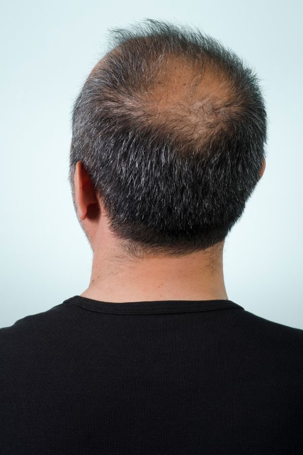 Mikropigmentacja skóry głowy Warszawa